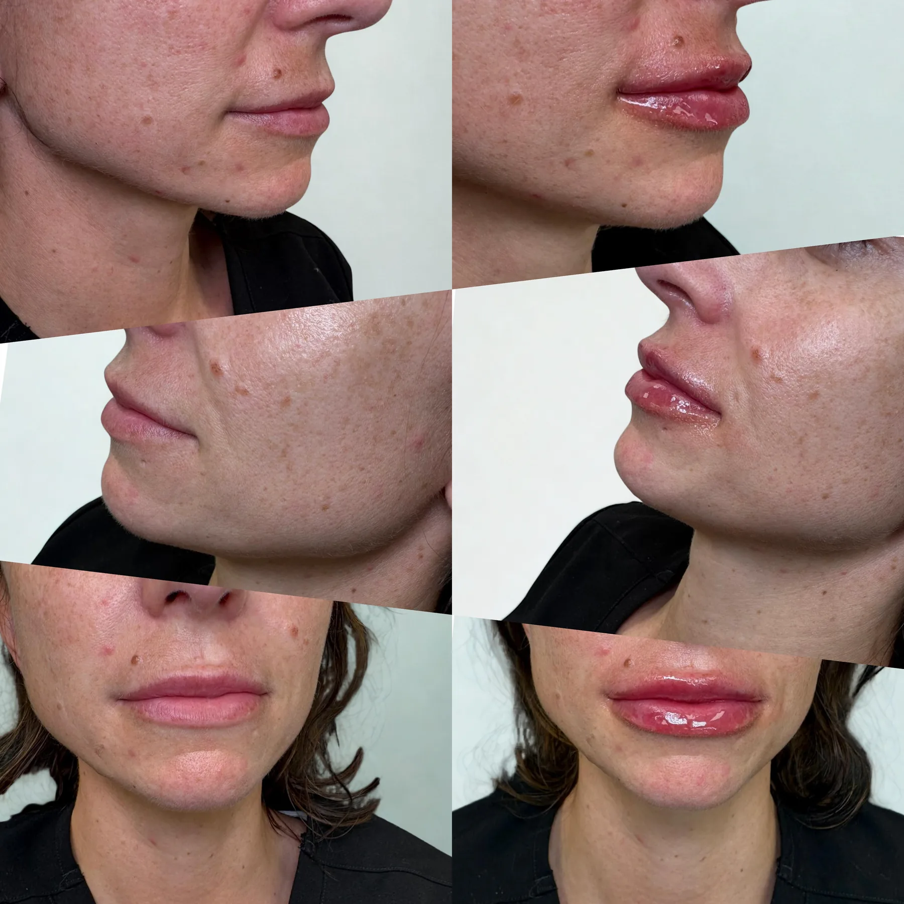 Oxybrasion Facial