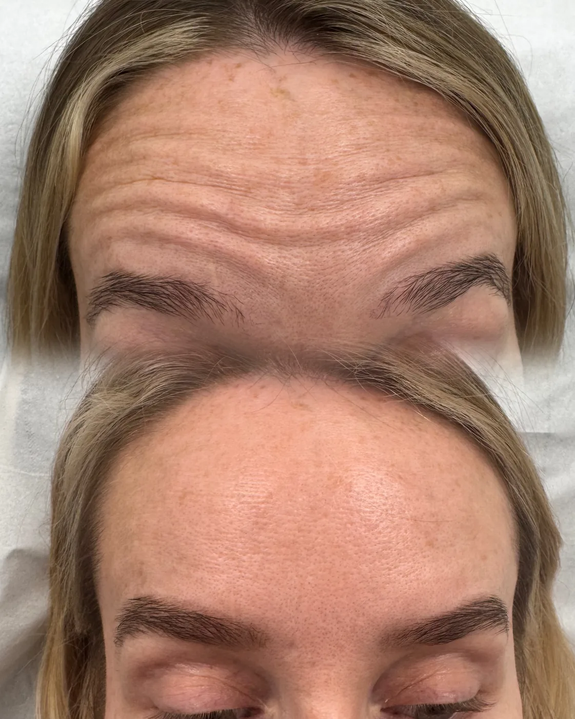Anti-wrinkle result