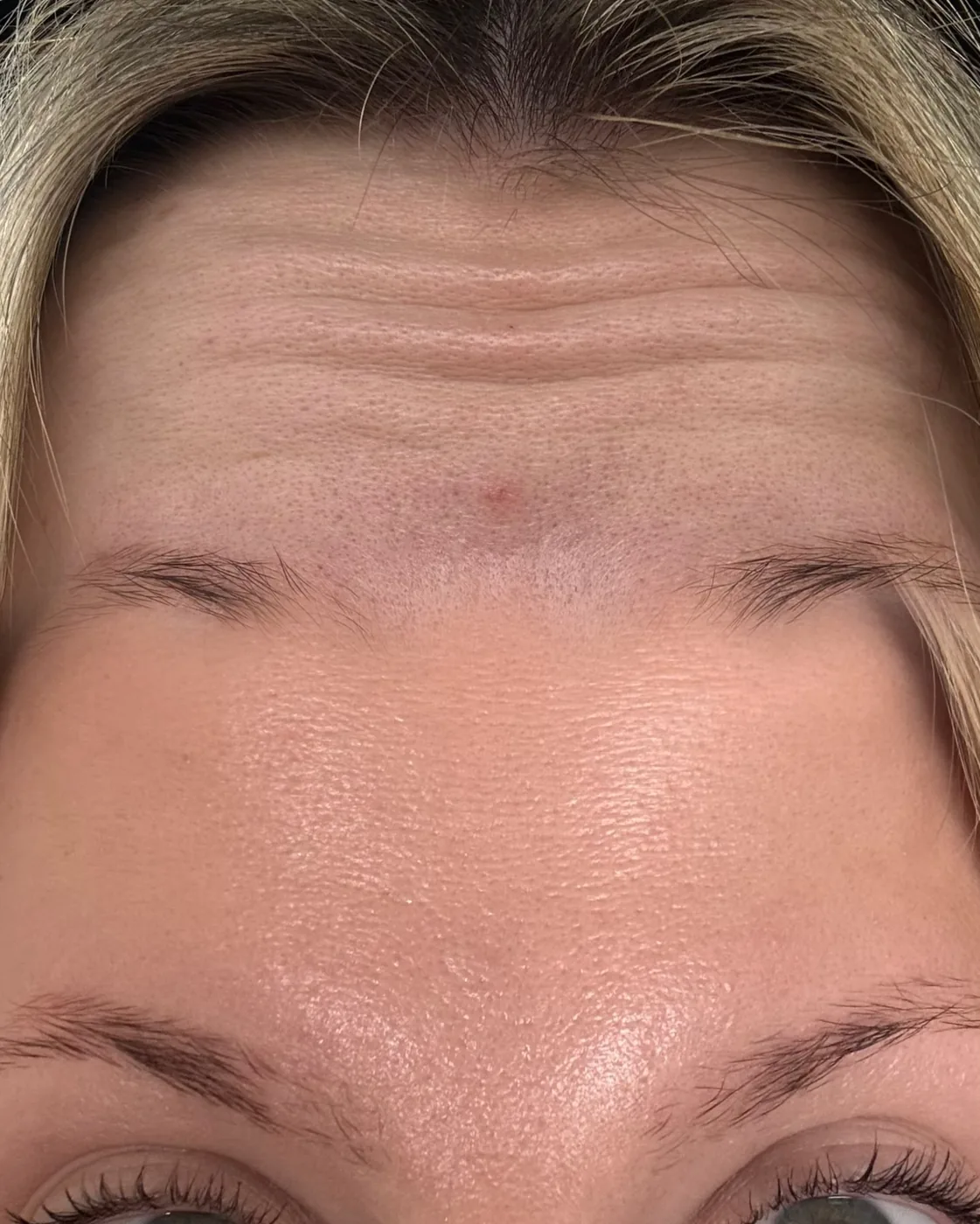 Anti-wrinkle result